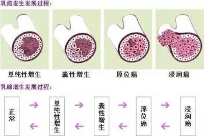 乳腺增生的七大治疗误区 